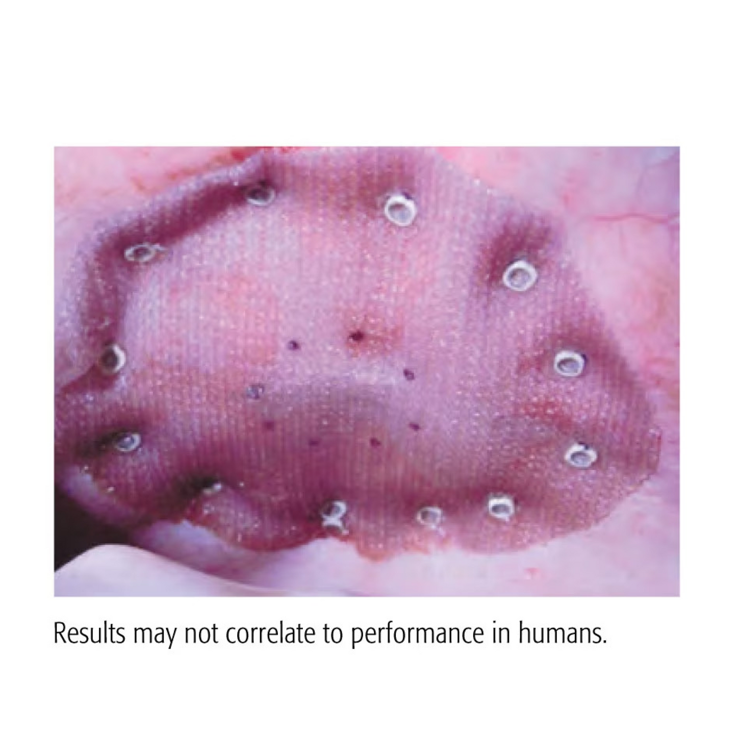 CapSure Fijador helicoideal Grapadora