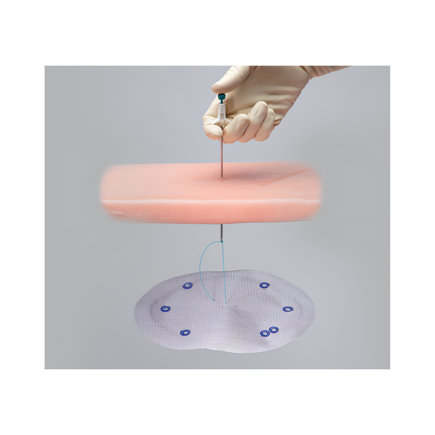 Ventralight ST Malla con Echo 2