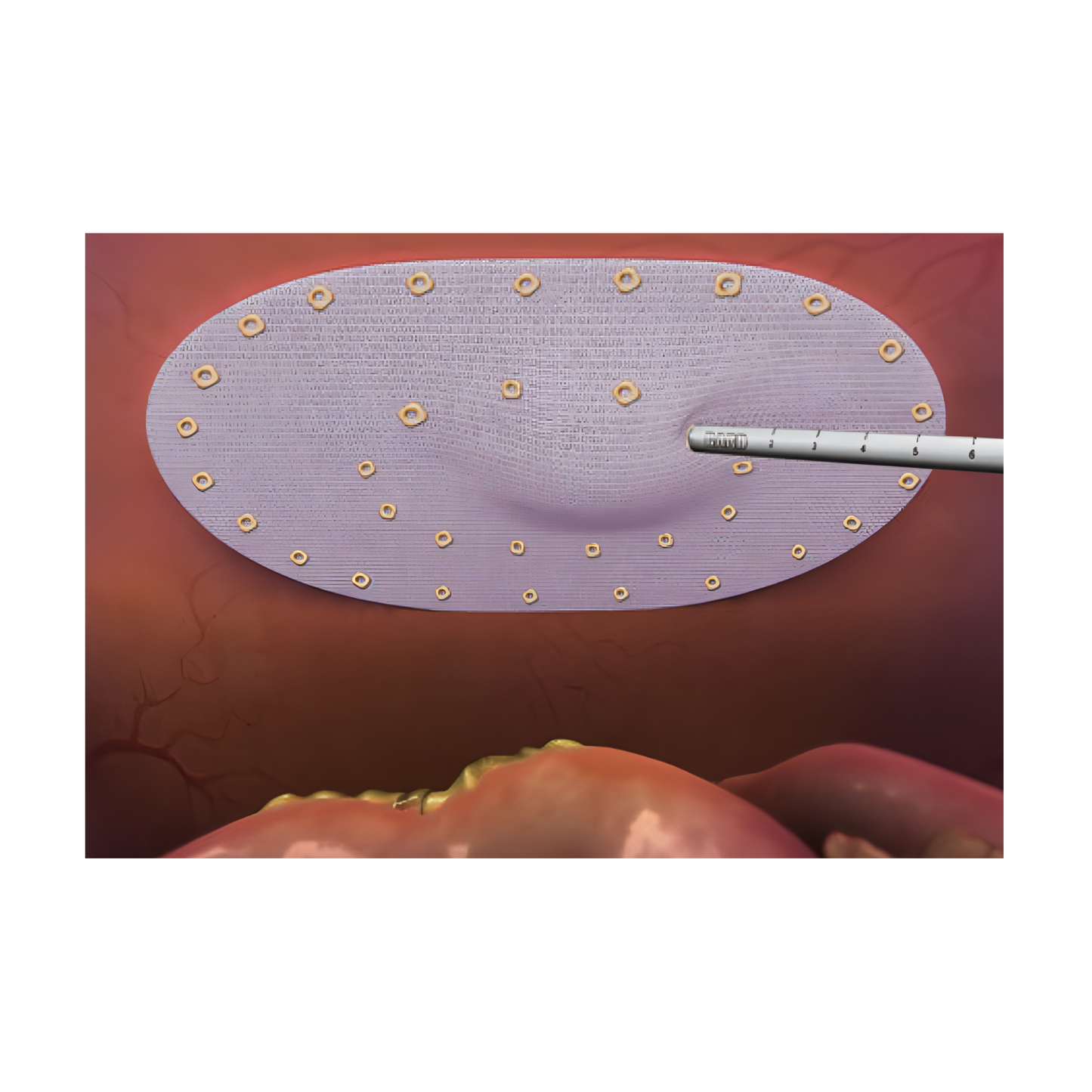 CapSure Fijador helicoideal Grapadora