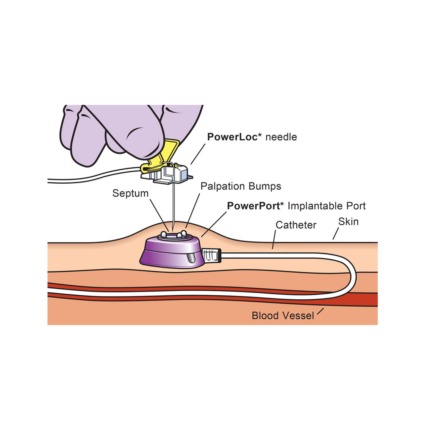 PowerPort  isp M.R.I. Puerto Implantable